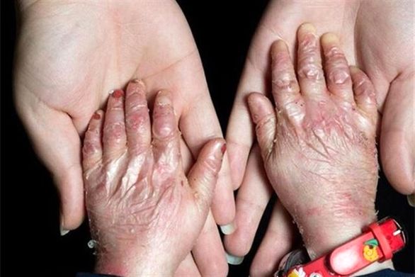 پانسمان ویژه بیماران پروانهای شامل تعهدات سازمانهای بیمهگر پایه نیست