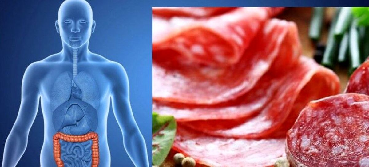سالانه ۲ میلیون نفر در دنیا به سرطان روده مبتلا میشوند