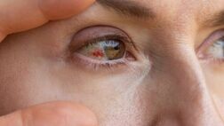 دلایل پارگی رگ خونی در چشم؛ چه موقع باید به پزشک مراجعه کنیم؟
