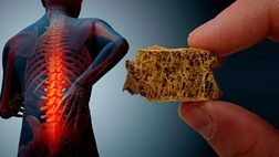 چگونه به پوکی استخوان مبتلا نشویم؟